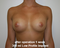 plastic-surgery-breast-augmentation